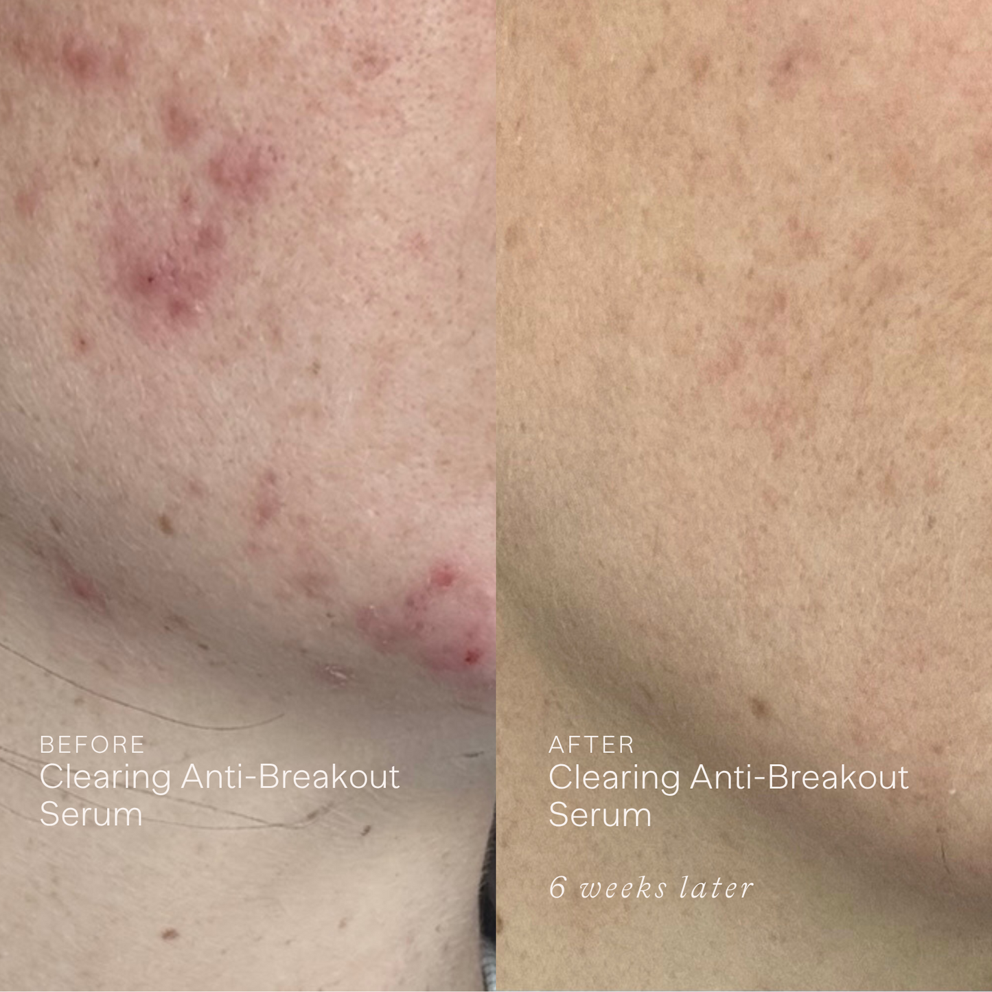 Clearing Anti-Breakout Serum