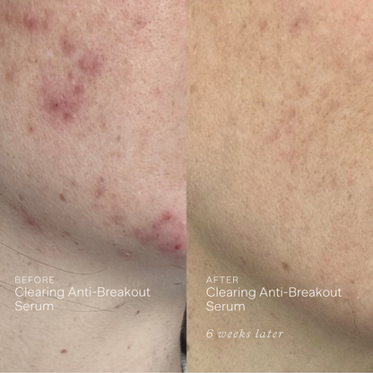 Clearing Anti-Breakout Serum