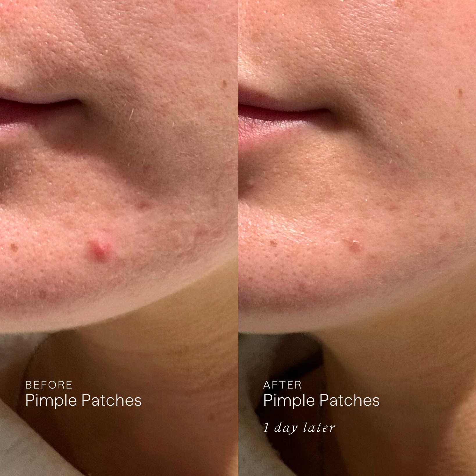 Patch Skin Pimple Patches – Senne Skin